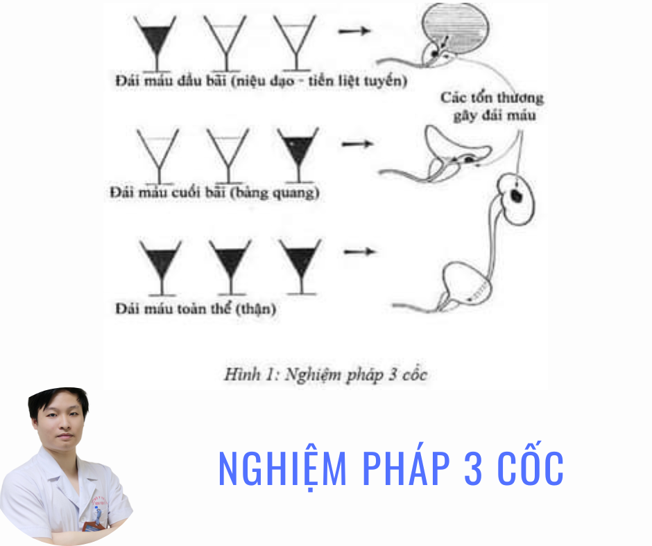 Nghiệm pháp 3 cốc xác định tiểu máu