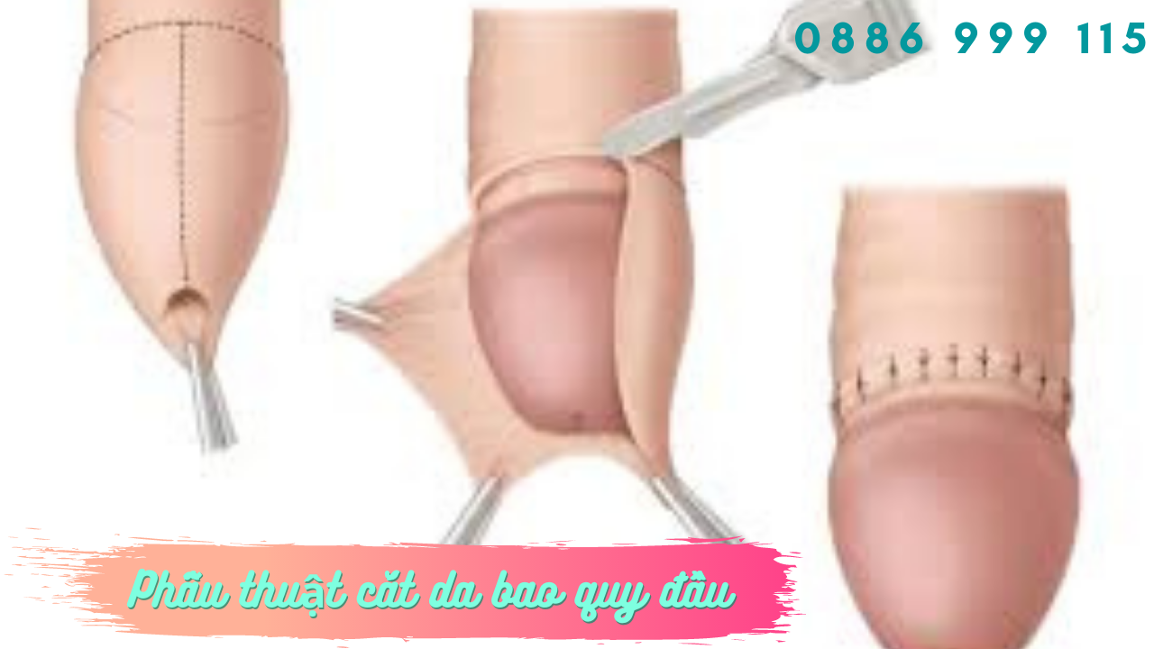 Phẫu thuật hẹp bao quy đầu