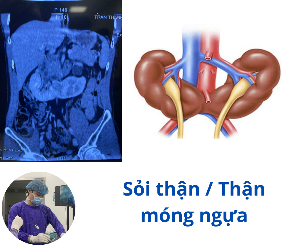 Sỏi thận ở bệnh nhân thận móng ngựa