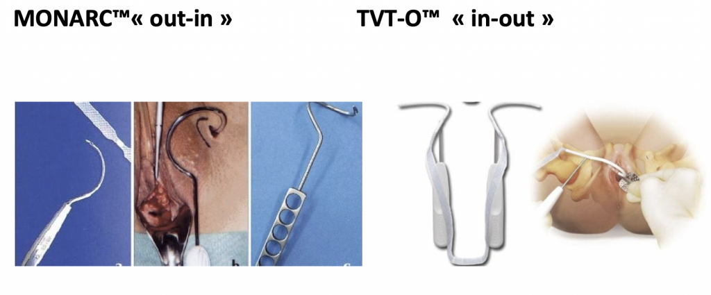 Phẫu thuật điều trị đái rỉ theo phương pháp Monarc-TVT