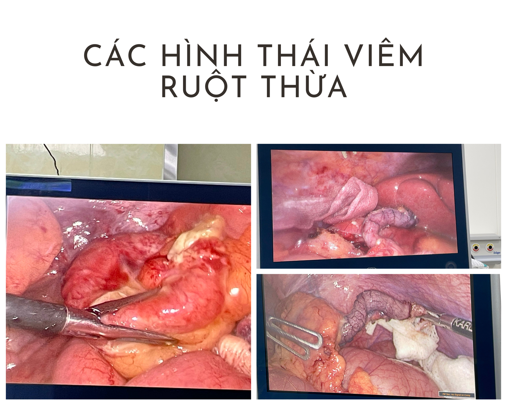 Viêm ruột thừa