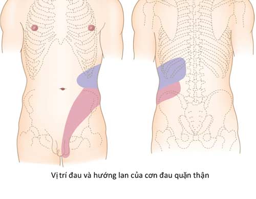 Cơn đau quặn thận