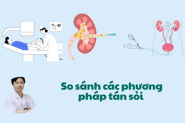 Hình ảnh minh họa so sánh các phương pháp tán sỏi thận hiện đại